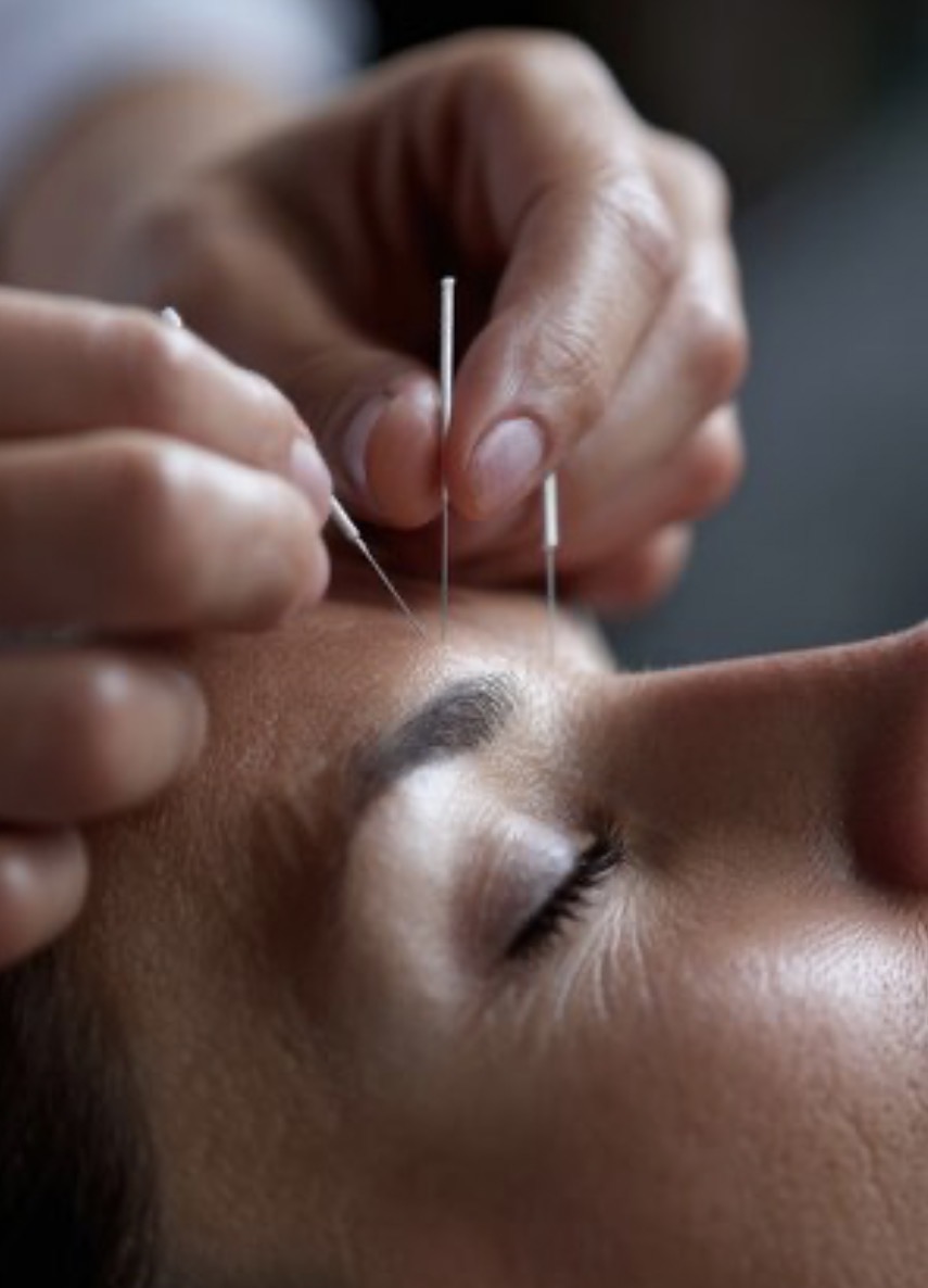 Rajeunissement Facial par l’acupuncture / Acupuncture Facial Rejuvenation